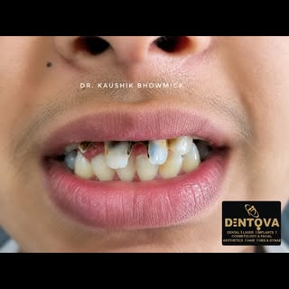From severely decayed anterior teeth to a confident smile restored with direct free-hand composite v