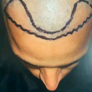 Hair line results 😊
