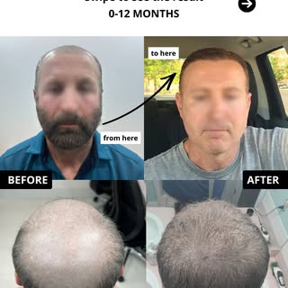 Norwood VII - Come take a look at this case!! 🔥

This patient presented with advanced hair loss, cl