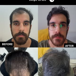 Grade 4.6 on the PRECISE scale

A case of diffuse thinning across the entire upper scalp, involving 