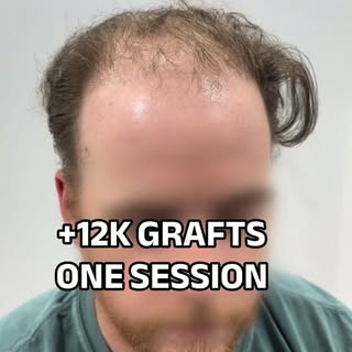 12K GRAFTS | GIGA SESSION

Aiming for maximum density and maximum coverage.

The priority is to achi