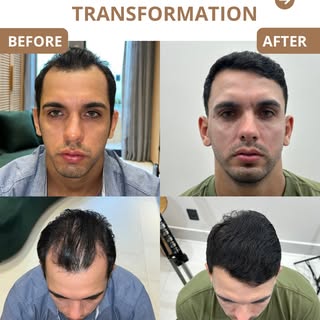 1 YEAR RESULTS 

We restored the frontal region with around 5k grafts. Now we’re preparing to restor