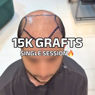 One session. One remarkable result.

This was one of the most advanced cases of baldness I’ve ever t