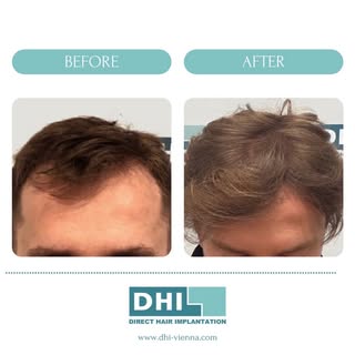Verabschiede dich von dünnem Haar und begrüße ein volles, natürliches Haarwachstum durch die DHI-Haa