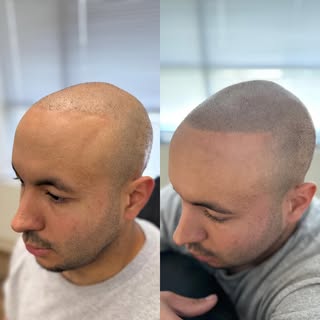 From transplant to transformation 🔥
This client already had a hair transplant — but wanted more den