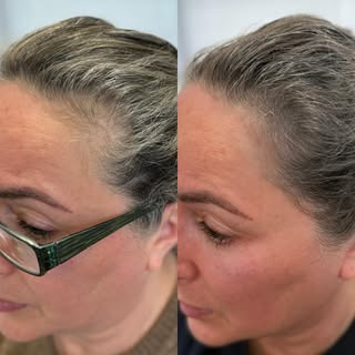 Scalp micropigmentation in the temple area due to alopecia. The blending couldn’t be more perfect.

