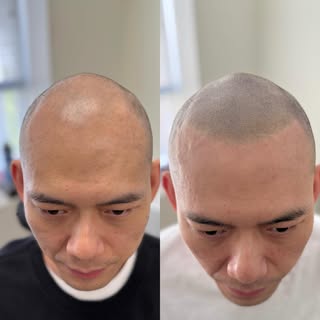 Soft and age-appropriate hairline ✅😎 Newfound confidence 🥳🎉 Doesn’t look like a block-head Lego m