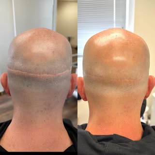 Hair transplants don’t always work as intended. You are then forced to shave your head — revealing t