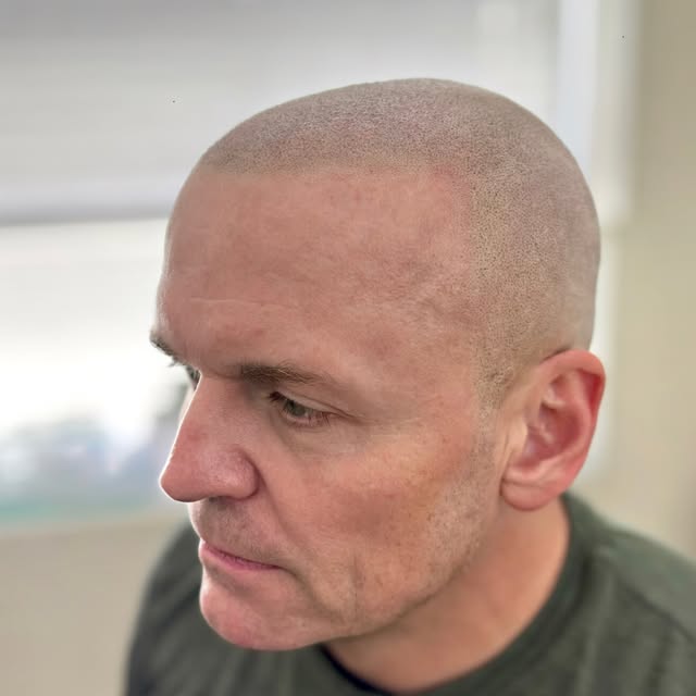 Healed results on the coolest white guy we’ve met. Norwood 7. Soft and natural hairline. Sweeeeet!😮