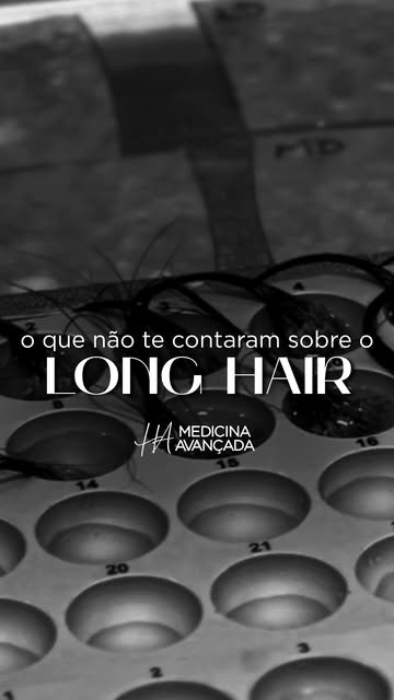 Long Hair: o que você precisa saber antes de escolher essa técnica.

O transplante sem raspagem pode