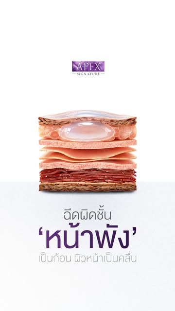 เติมฟิลเลอร์ผิดชั้น 
หน้าพัง เป็นก้อน! 🪨

เพราะใบหน้าไม่ได้มีแค่ “ชั้นผิว” 
เดียว การเติมฟิลเลอร์จึ