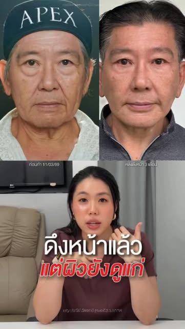 ดึงหน้าแล้ว แต่ทำไมยัง “ดูมีอายุ” ?
เพราะปัญหาวัยผู้ใหญ่ไม่ได้จบแค่ความหย่อนคล้อย

APEX วิเคราะห์ปัญ