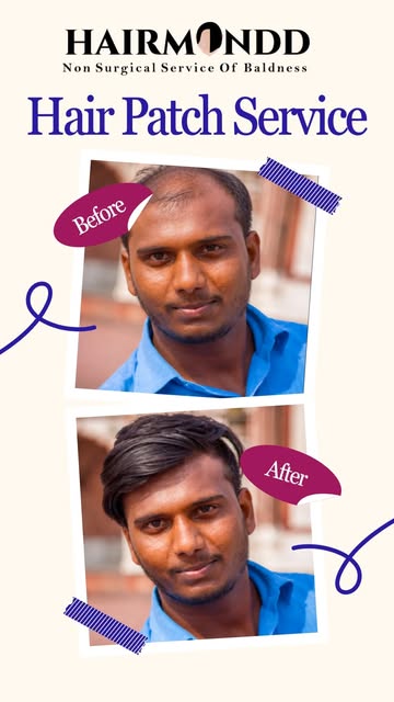 Experience a seamless life transformation with Hairmondd's non-surgical hair patch service. 

Regain