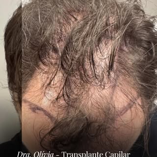 Transplante capilar devolve muito mais que cabelos : devolve confiança, autoestima e bem estar!
 
Se