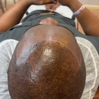 Hyperpigmentation on the scalp doesn’t mean you can’t deliver a clean, natural SMP result—it just me