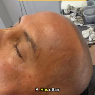 Other cases were Scalp1 micro pigmentation can use SMP to make a major impact. Areas such as the eye