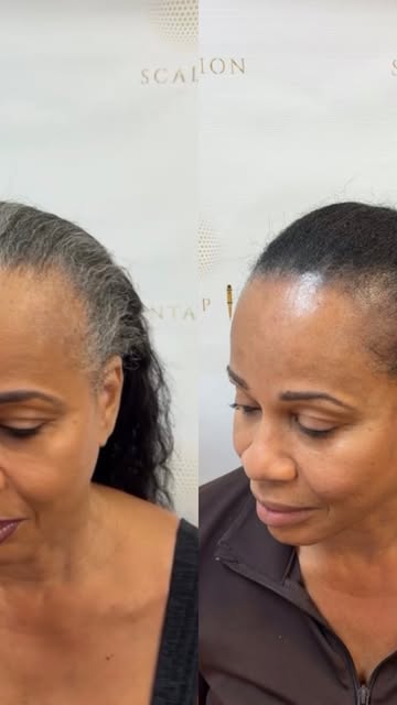 Adding density to hair with SMP, scalp micropigmentation #SMPForWomen#SMP#Density#HairDensity