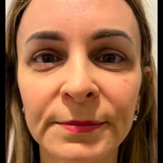 ✨ Résultat naturel, élégance intemporelle ✨

Cette magnifique patiente de 36 ans est à 6 semaines d’