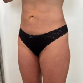 ✨ SCULPTED. NATURAL. CONFIDENT. ✨

This beautiful 43-year-old patient is now 3 months post liposucti