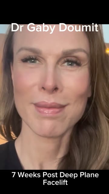 ✨ 7 WEEKS AFTER DEEP PLANE FACELIFT ✨

At 52, this lovely patient is just 7 weeks post-op and alread