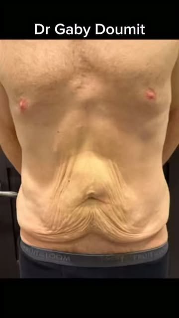 ✨ 6 WEEKS AFTER BODY LIFT | MASSIVE WEIGHT LOSS TRANSFORMATION ✨

At 54, this gentleman is only 6 we