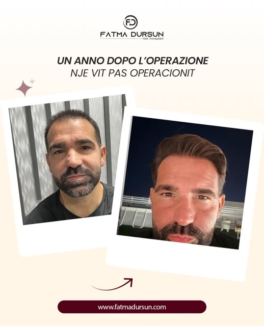 Dopo il trapianto: un risultato naturale, armonioso e duraturo. ✨

La soddisfazione di un cambiament