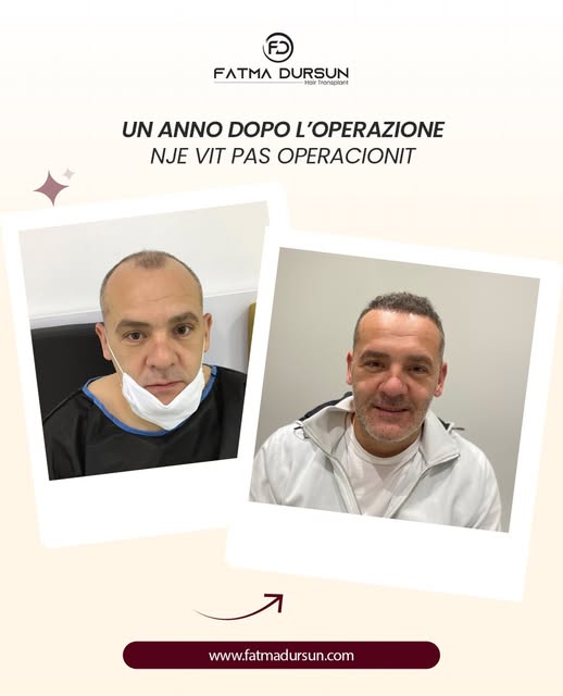 Un trapianto di capelli ben pianificato non mira solo al risultato iniziale, ma anche a un aspetto n
