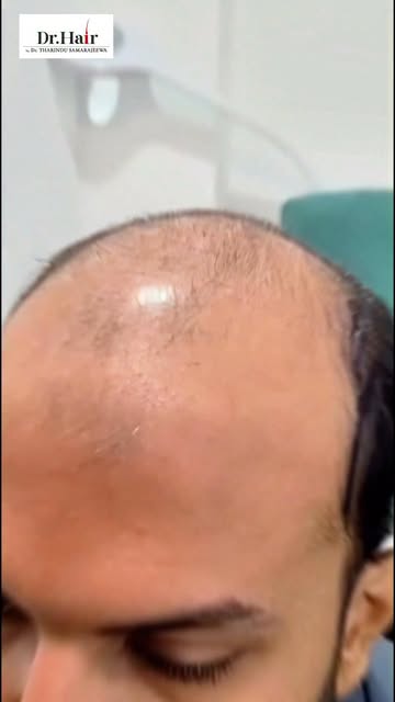 Grade 7 baldness is the most advanced stage of hair loss, and patients are often told nothing can be