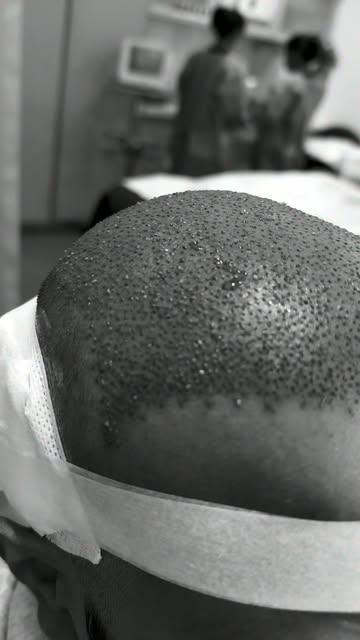 Hair transplant surgery at Dr Hair by Dr Tharindu Samarajeewa, Ninewells Hospital, Sri Lanka  #drhai