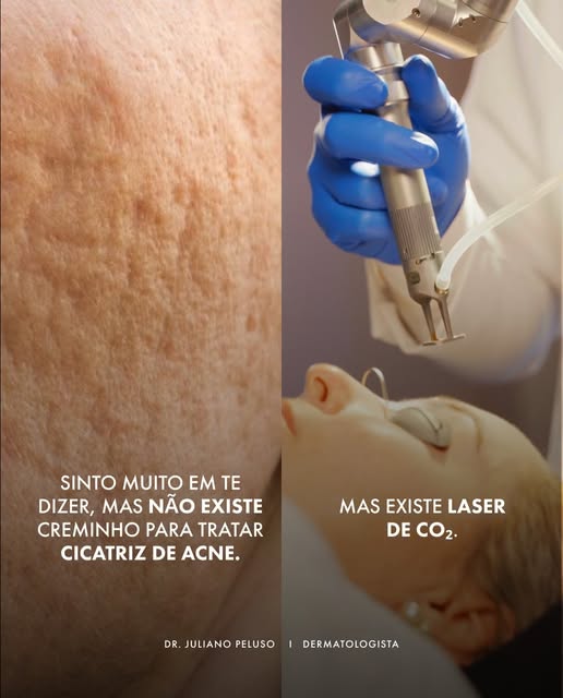 As cicatrizes de acne costumam permanecer por muitos anos e, por isso, muita gente acaba acreditando