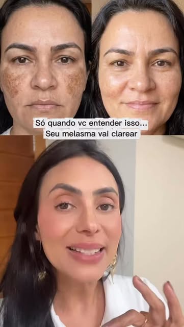 Você pode usar clareador, fazer procedimentos e até usar hidroquinona…

Mas enquanto a inflamação co