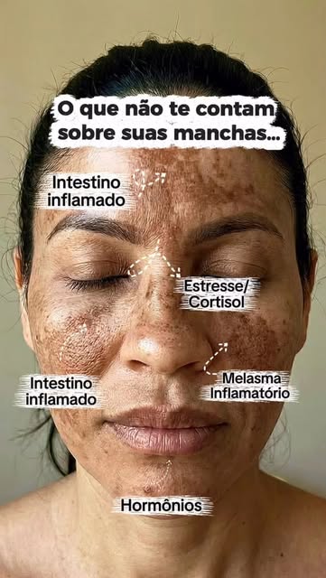 O que não te contam sobre suas manchas.

Você pode usar os melhores cremes, fazer procedimentos e in
