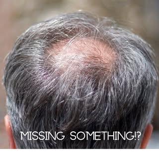 To schedule a FREE consultation call our office at (480)970-0300  #MissingSomething #HairLoss #FUT #