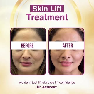 " Many patients come to us with concerns like:

💜 Loose or sagging skin
💜 Visible fine lines & wri