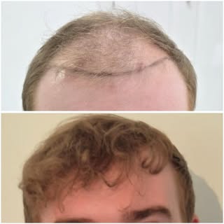 Another fantastic result coming in 12 months post op. We couldn’t be happier for this patient and no