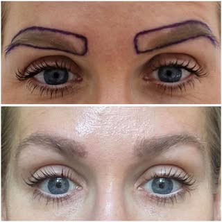 Amazing eyebrow transplant result - just 6 months post op! 🤩

Hair transplants aren’t just for your