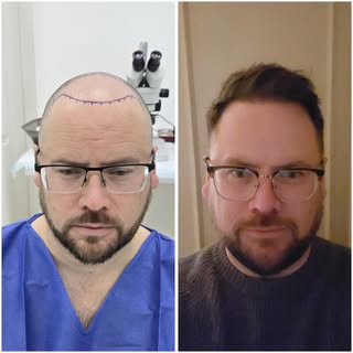 📈 RESULT TIME 📈

12 Months post op and this result is looking amazing. The hair will now thicken a