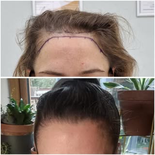 Think hair transplants are just for men? Think again!

This patient came to us wanting us to lower h