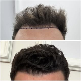 Sometimes the changes only need to be subtle to make a big difference. This patient came to us to ad