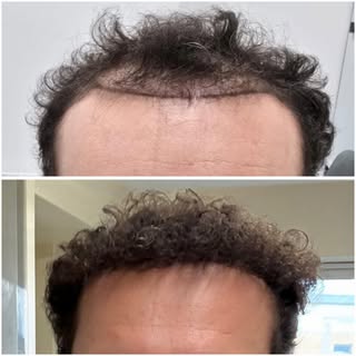 Another incredible transformation. 🌱

Our patient’s journey is a reminder that great results come w