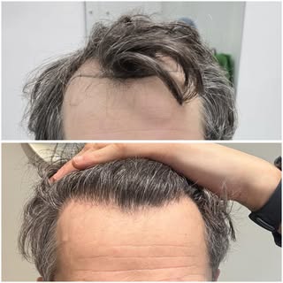 From thinning hair to a fuller, natural-looking hairline ✨

Every hair transplant journey is unique,