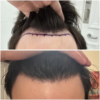 🚨 Hairline transformation alert 🚨

From visible recession to a stronger, natural-looking hairline.