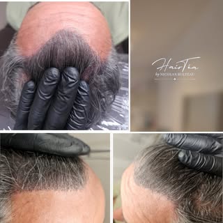 🔹 Camoufler une ligne frontale reculée ?
La tricopigmentation permet de redessiner une ligne nature