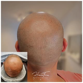 🌟 effet rasé garanti, résultat naturel 🌟

La tricopigmentation permet de recréer l’illusion parfai