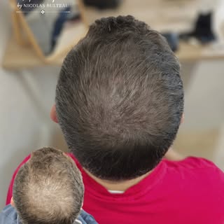 La tricopigmentation repose avant tout sur la bonne technique : celle qui permet au résultat de viei