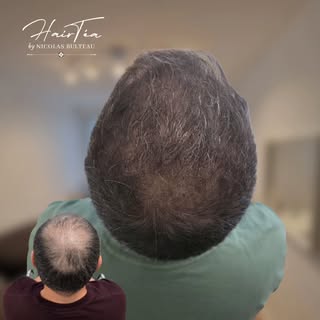 ✨️ Super résultat en effet densité ✨️

La tricopigmentation permet de camoufler les zones clairsemée
