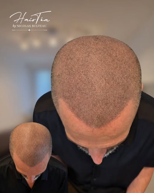 3 ans après… il est temps de redonner de l’éclat à sa tricopigmentation.

Sur cet avant/après, la tr