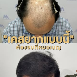 ✨ "เคสยากแบบนี้... ต้องจบที่หมอเบญ" 💇‍♂️
 การปลูกผมเคสพื้นที่กว้าง ไม่ใช่แค่เรื่องปลูกให้เต็ม 
แต่ต