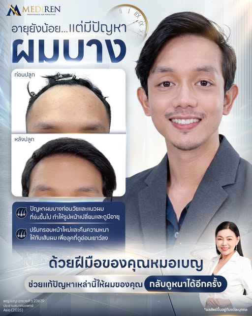 ✨ อายุยังน้อย... แต่เริ่มกังวลเรื่องผมบางและแนวผมร่นก่อนวัย! 
ปัญหาผมร่นทำให้รูปหน้าเปลี่ยนและดูมีอา