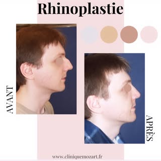 RHINOPLASTIE :
 
La #rhinoplastie a pour but d’harmoniser le #nez avec le reste du visage ✨
Cette in